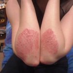 Photos of psoriasis on hands