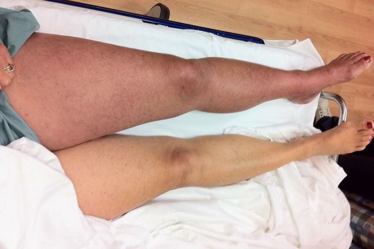 Pictures of DVT in leg