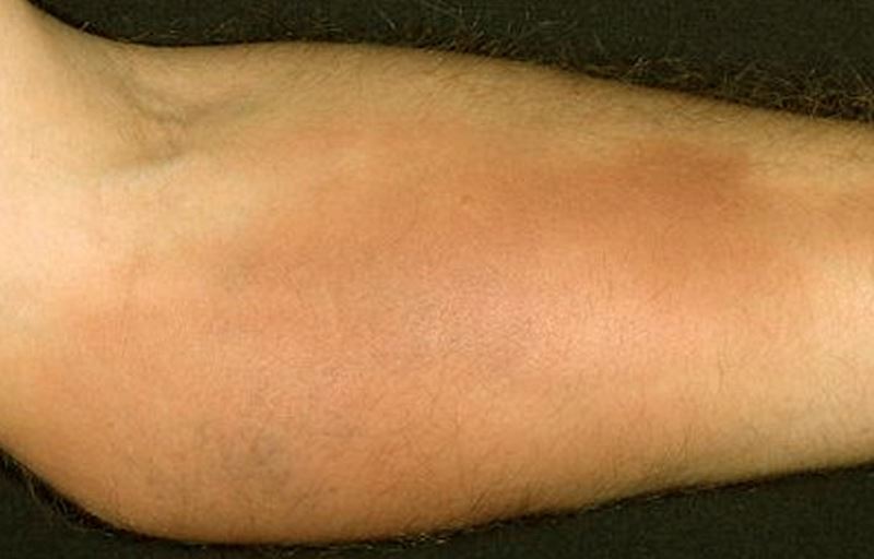 Pictures of phlebitis in the arm