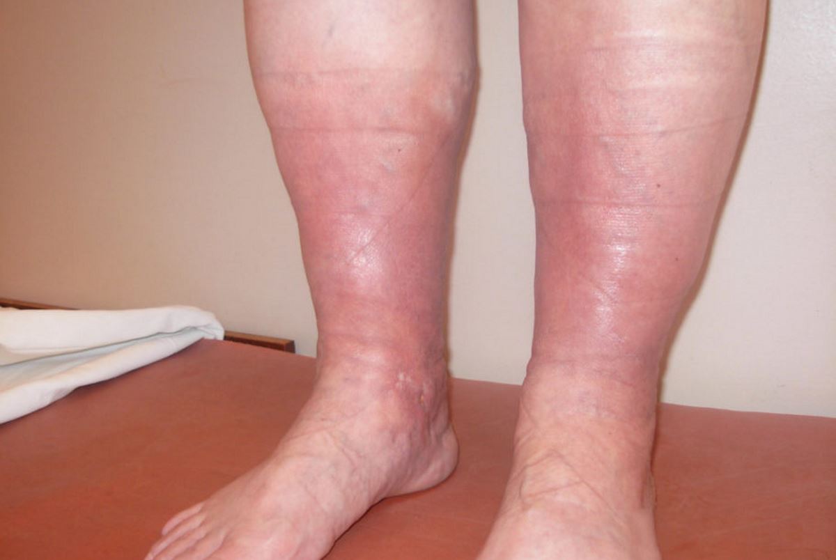 Pictures of phlebitis in the leg