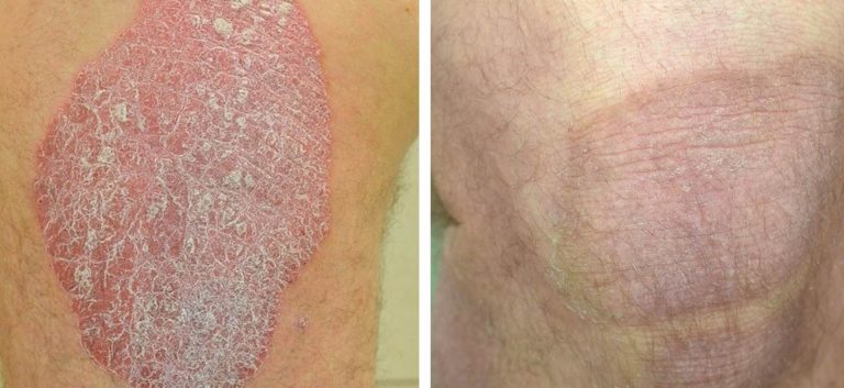 Pictures of plaque psoriasis on legs | Symptoms and pictures