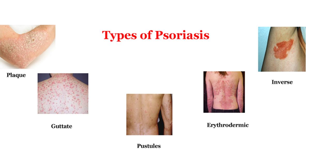 Pictures of psoriasis types