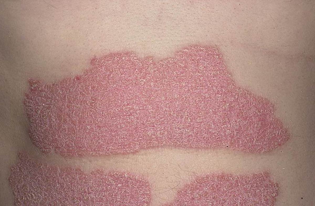 Plaque psoriasis symptoms pictures