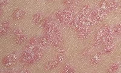 Psoriasis on body pictures 2