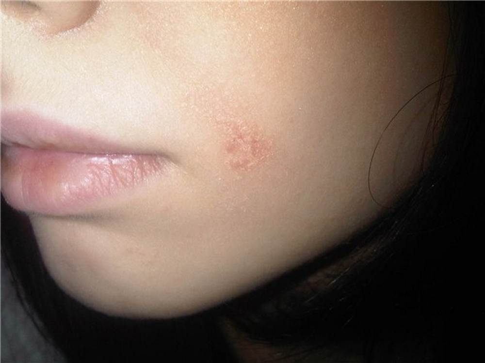 Psoriasis On Face Pictures Symptoms And Pictures