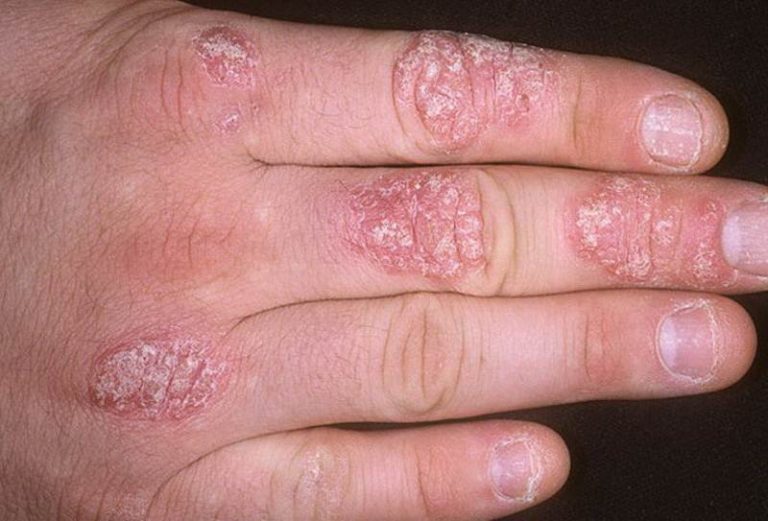 Psoriasis on hands photos | Symptoms and pictures