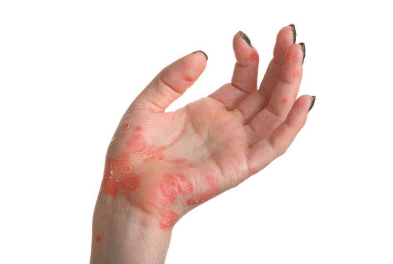 Psoriasis on hands pictures