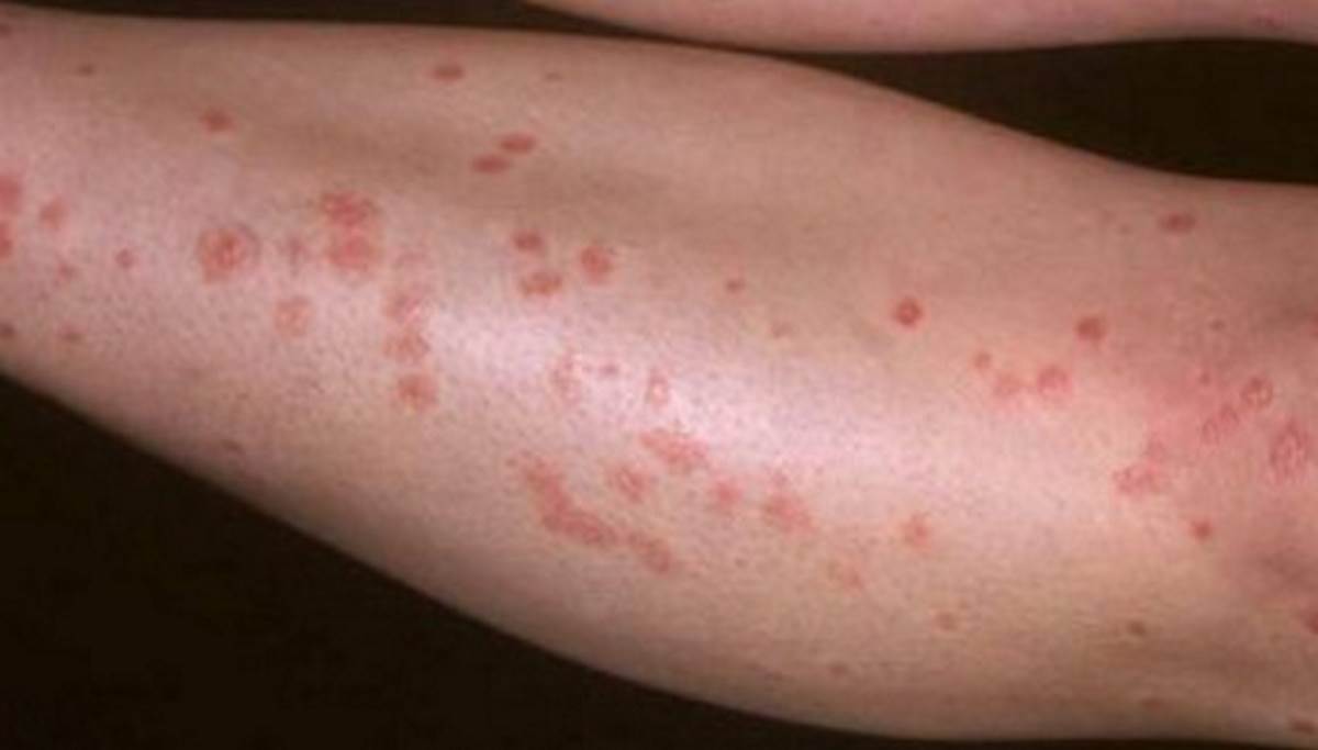 Psoriasis on legs pictures