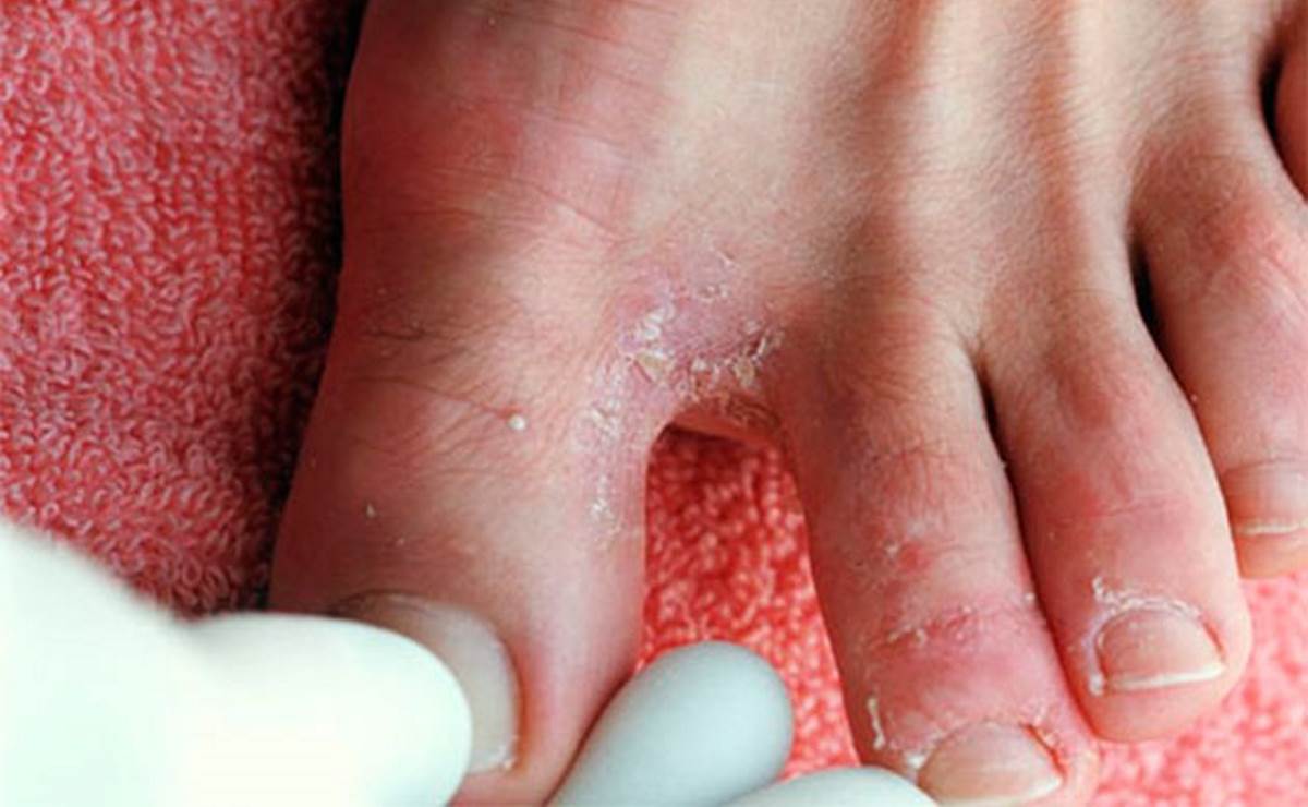 Psoriasis on toes pictures 2