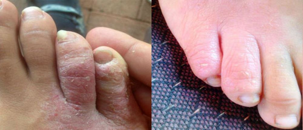 Psoriasis on toes pictures