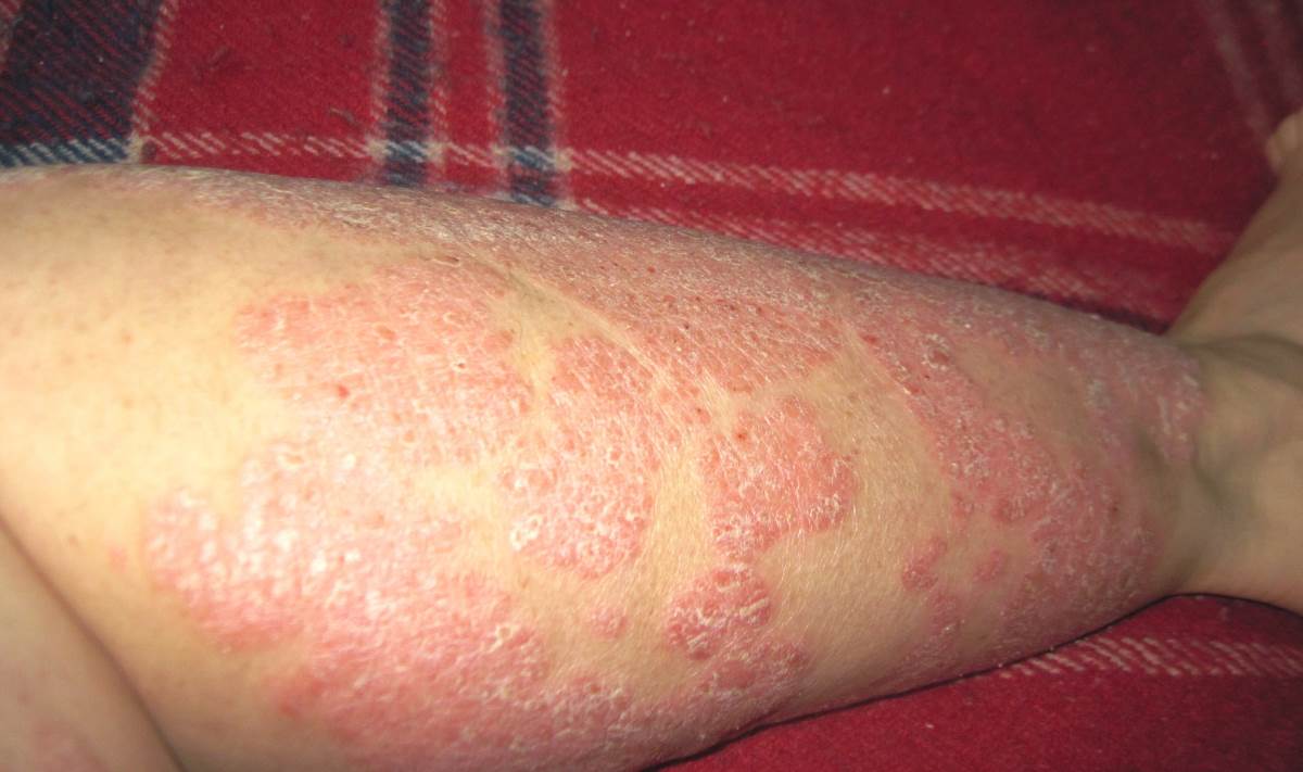 Psoriasis pics on legs