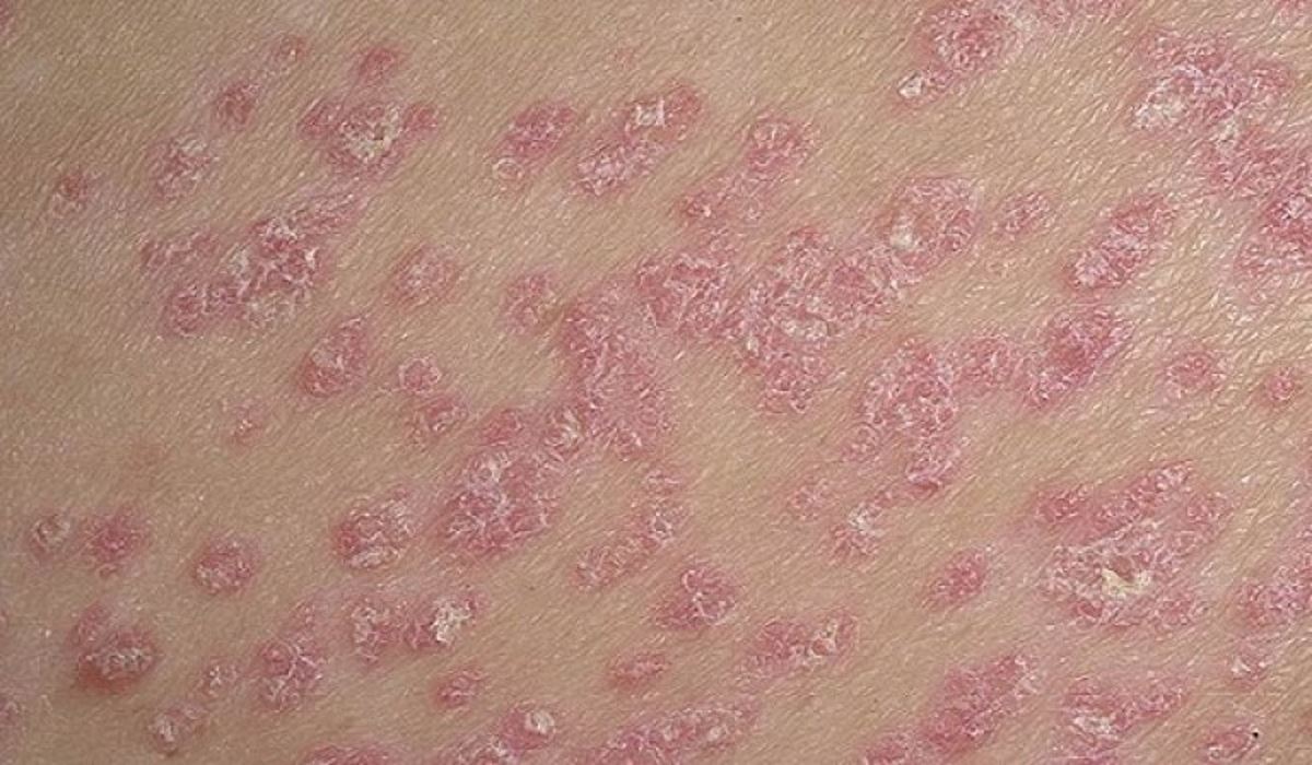 Psoriasis pictures on body