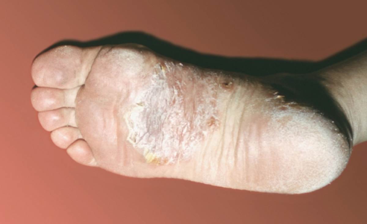 Pustular psoriasis feet photos