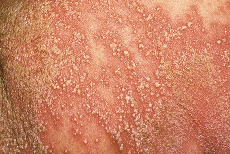 Pustular psoriasis images