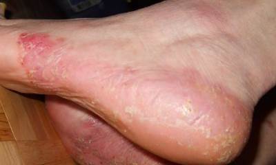 Pustular psoriasis on feet pictures 2