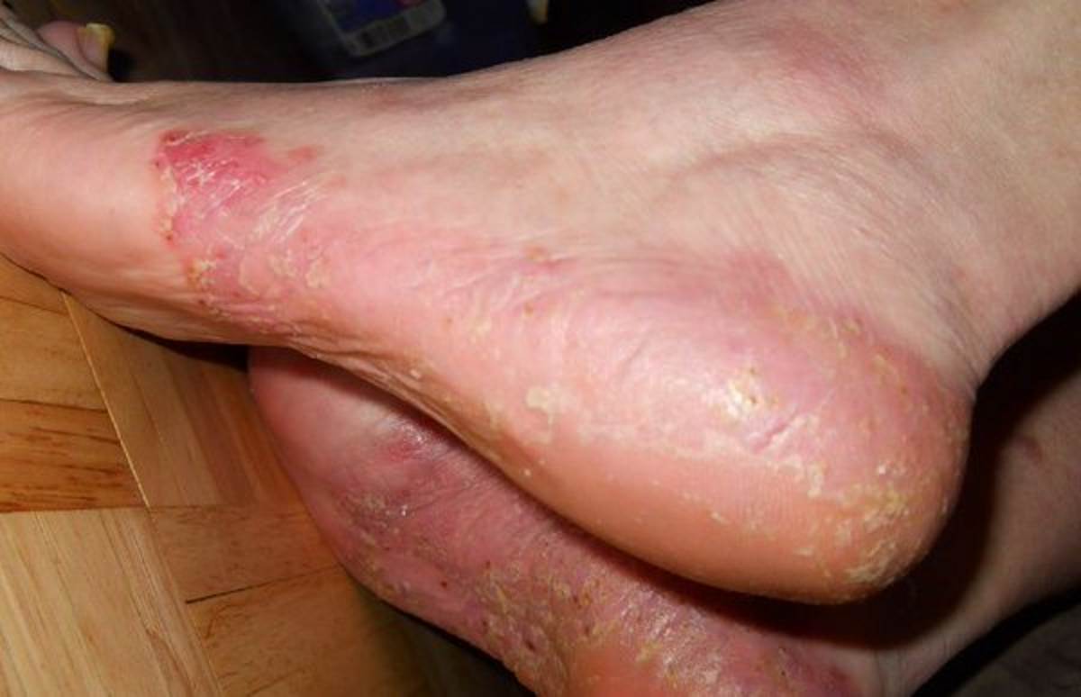 Pustular psoriasis on feet pictures