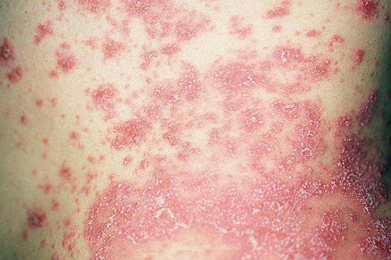 Pustular psoriasis pictures