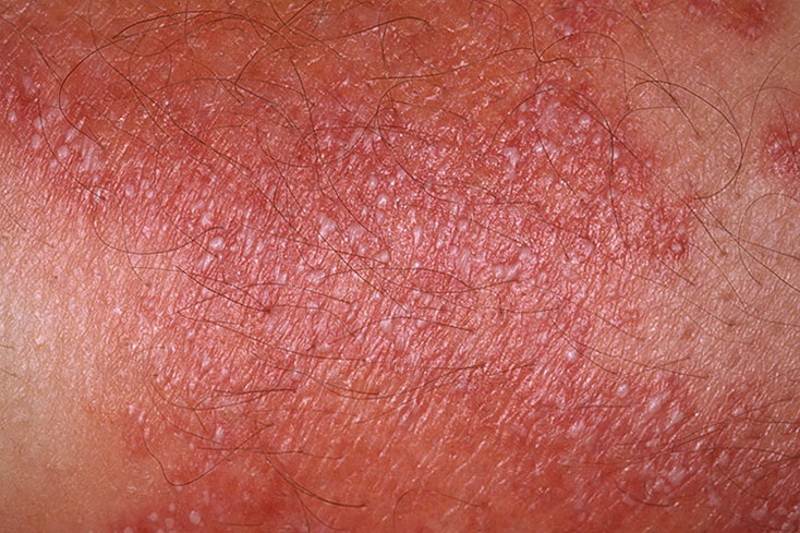 Pustular psoriasis symptoms pictures