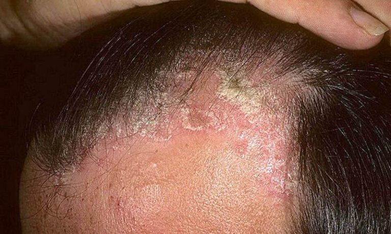 Scalp psoriasis images | Symptoms and pictures