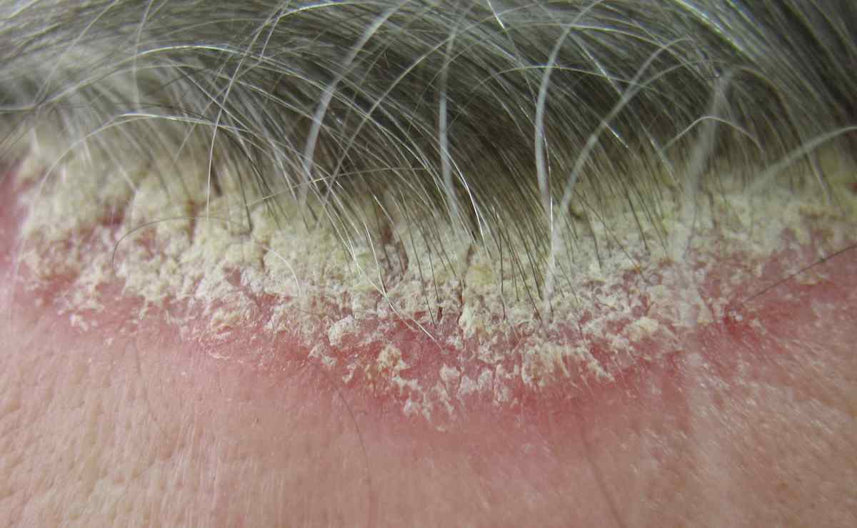 scalp-psoriasis-scales-pictures-symptoms-and-pictures