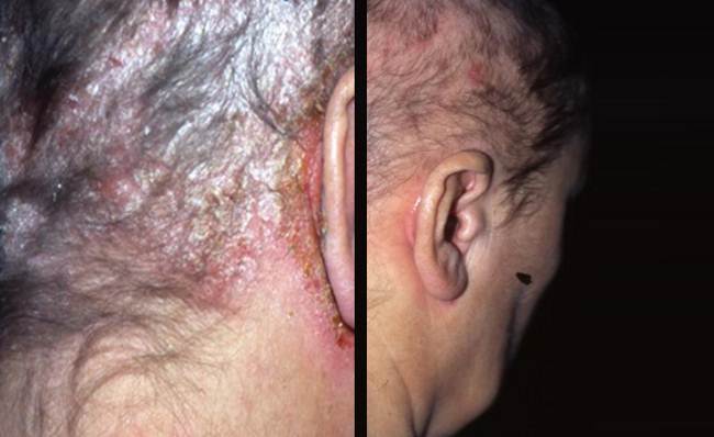 Scalp psoriasis treatment