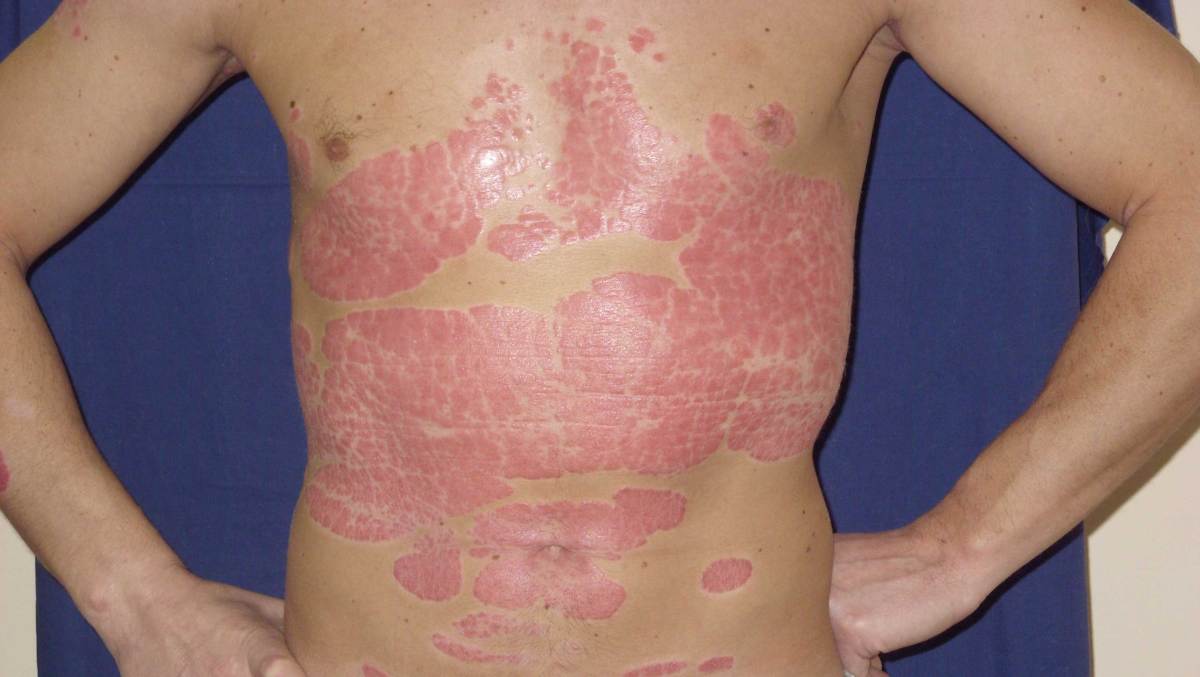 Severe Plaque Psoriasis Photos Symptoms And Pictures 