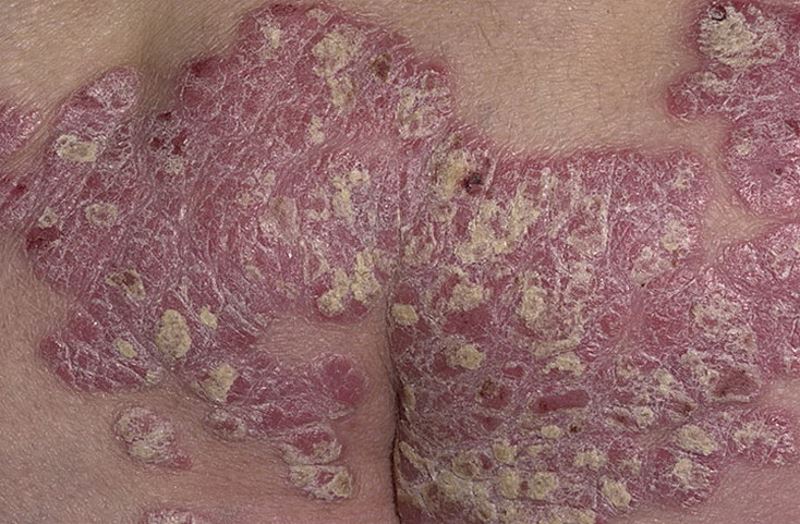 Severe plaque psoriasis pictures