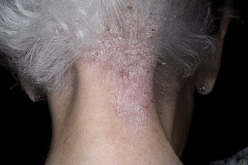 Severe psoriasis pictures 2