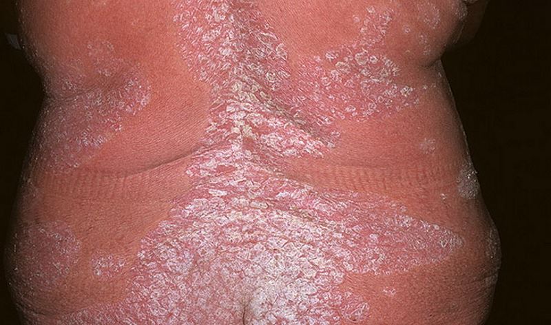 Severe psoriasis pictures