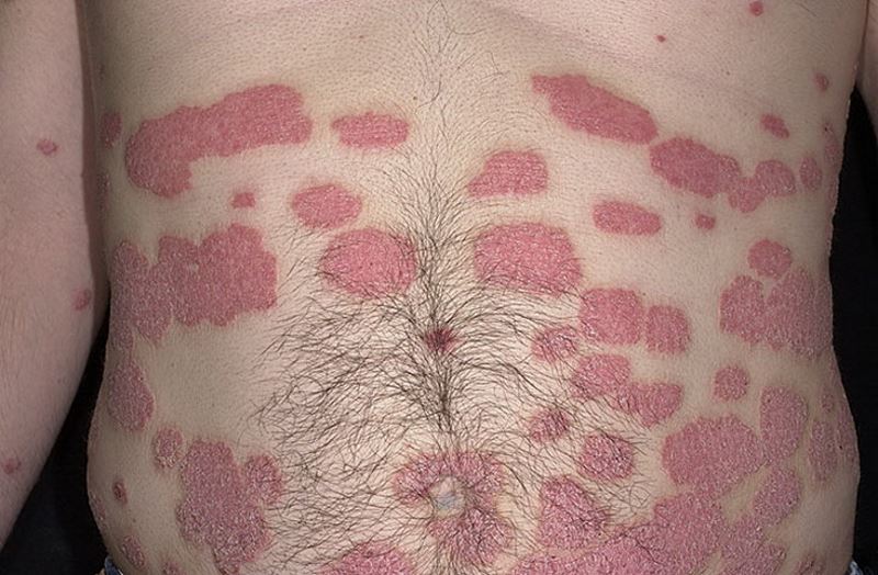 Severe psoriasis symptoms pictures