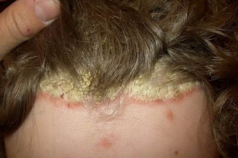 Severe scalp psoriasis images