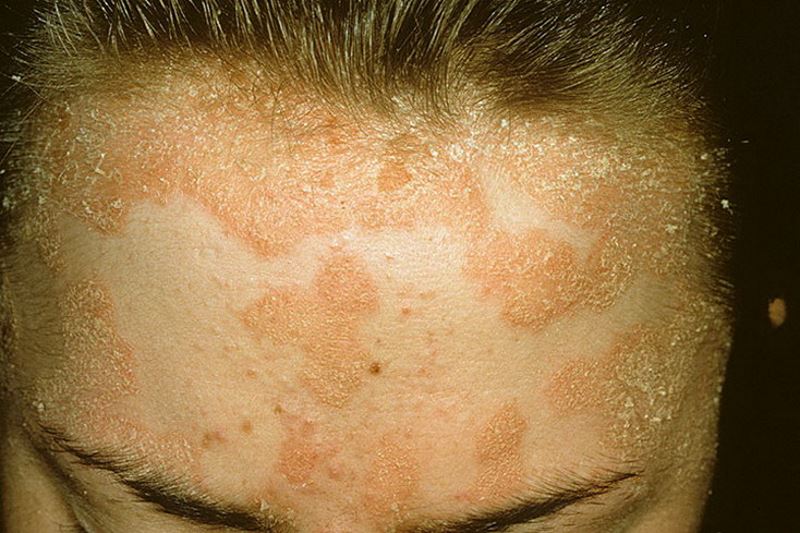 Severe scalp psoriasis pictures