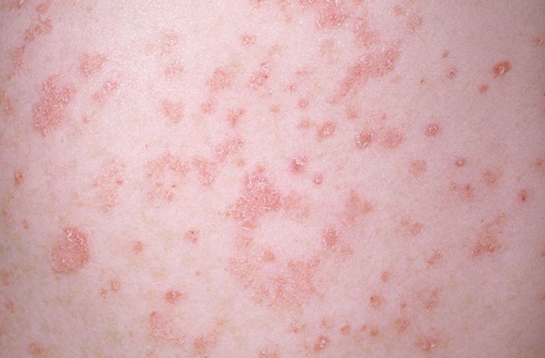 Show me pictures of psoriasis | Symptoms and pictures