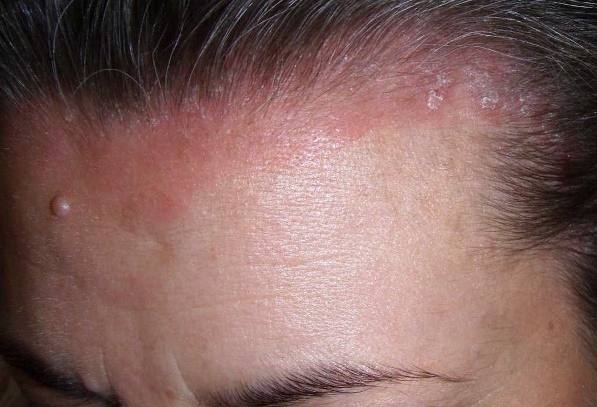 Show pictures of psoriasis