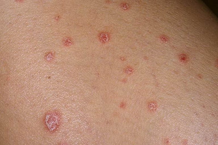 Signs and symptoms of psoriasis pictures | Symptoms and pictures