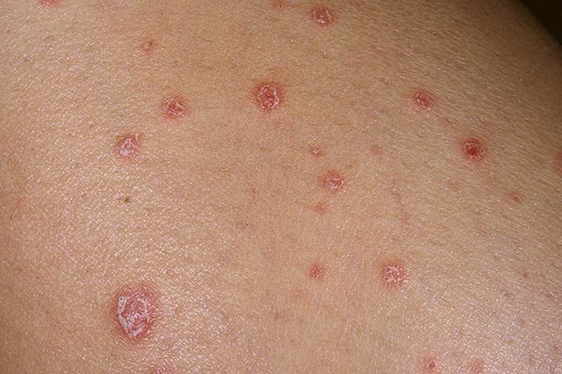 Signs and symptoms of psoriasis pictures