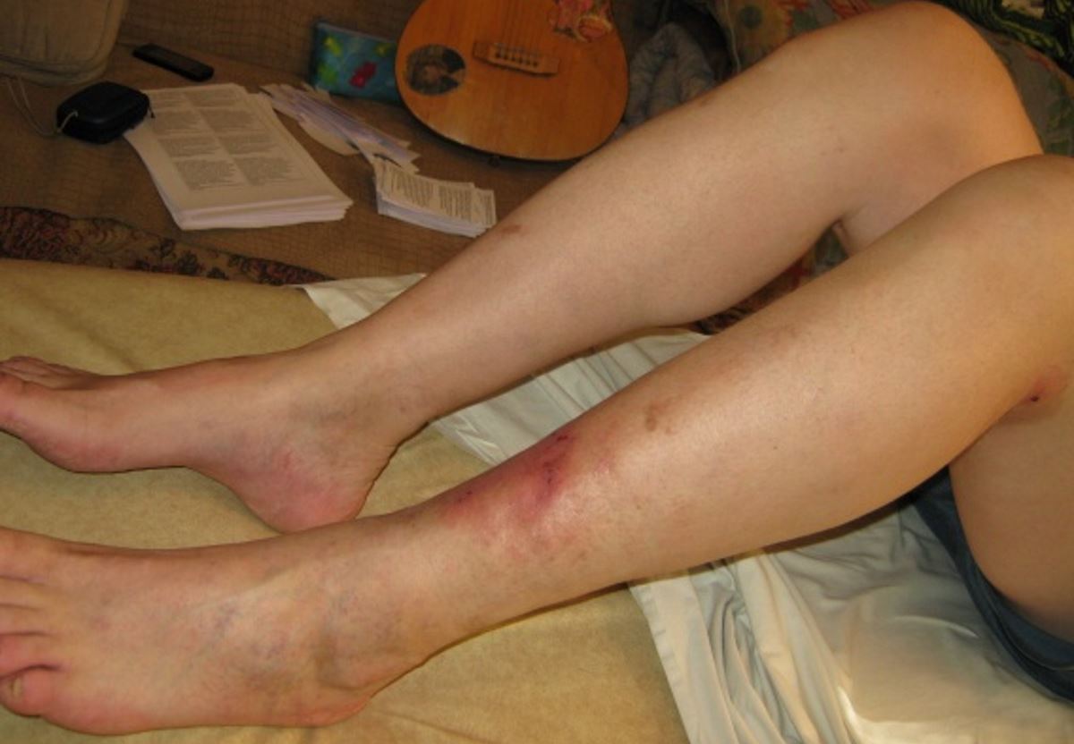 Signs of DVT in lower leg pictures