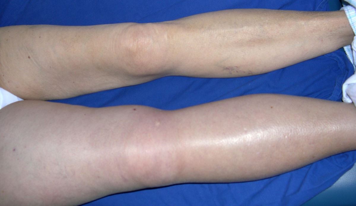 Signs of deep vein thrombosis images