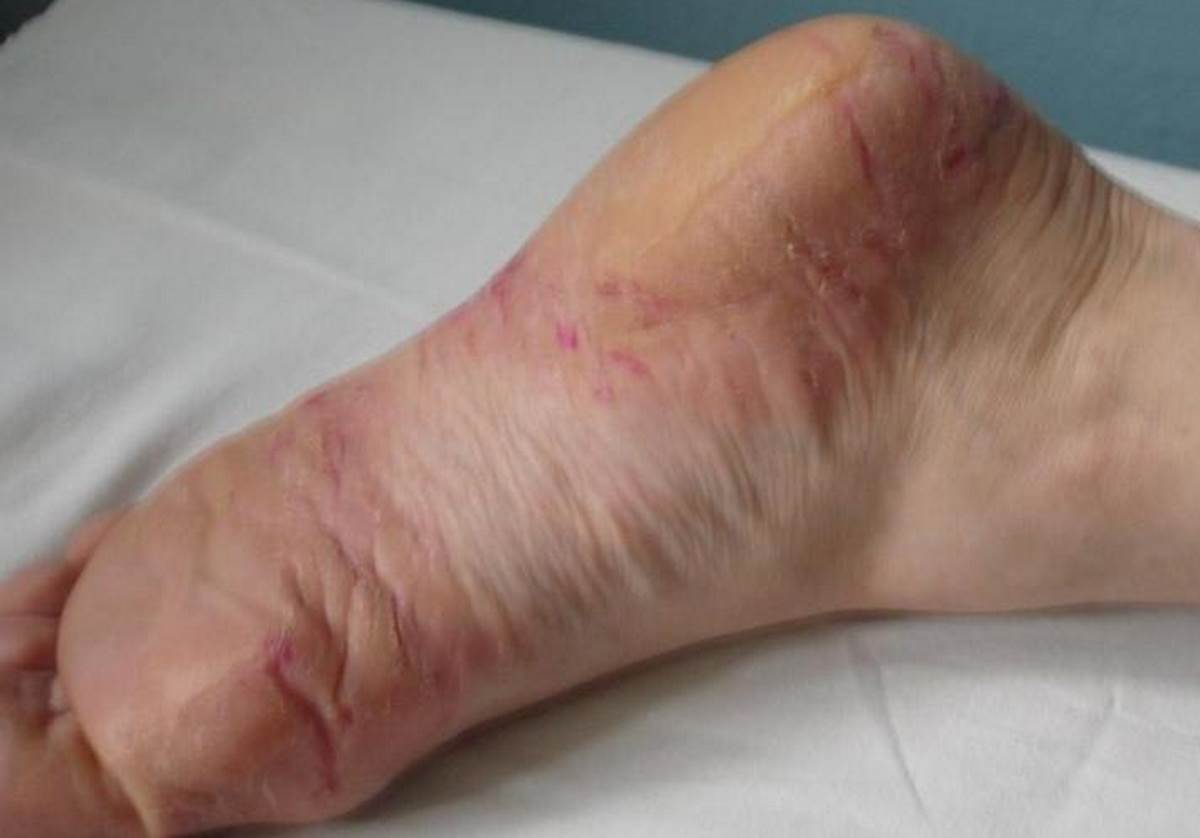 Signs of psoriasis on feet images