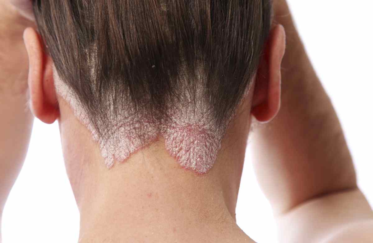 Signs of scalp psoriasis pictures