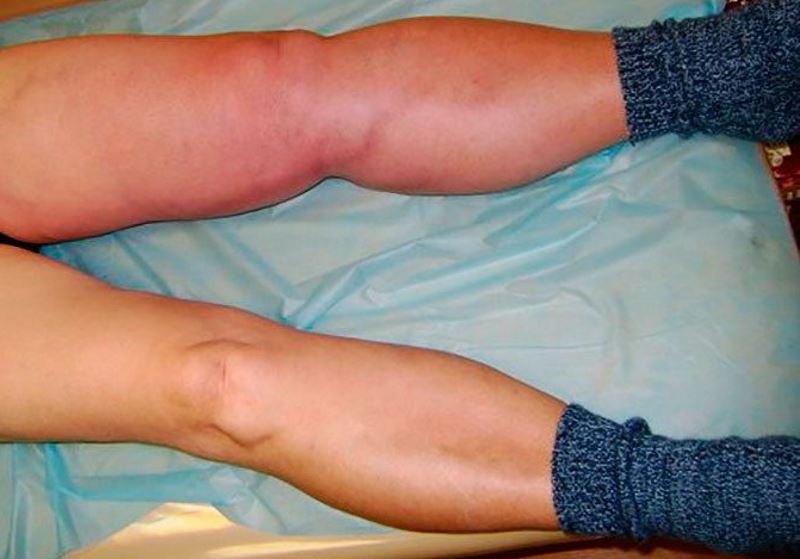 Signs of thrombosis pictures