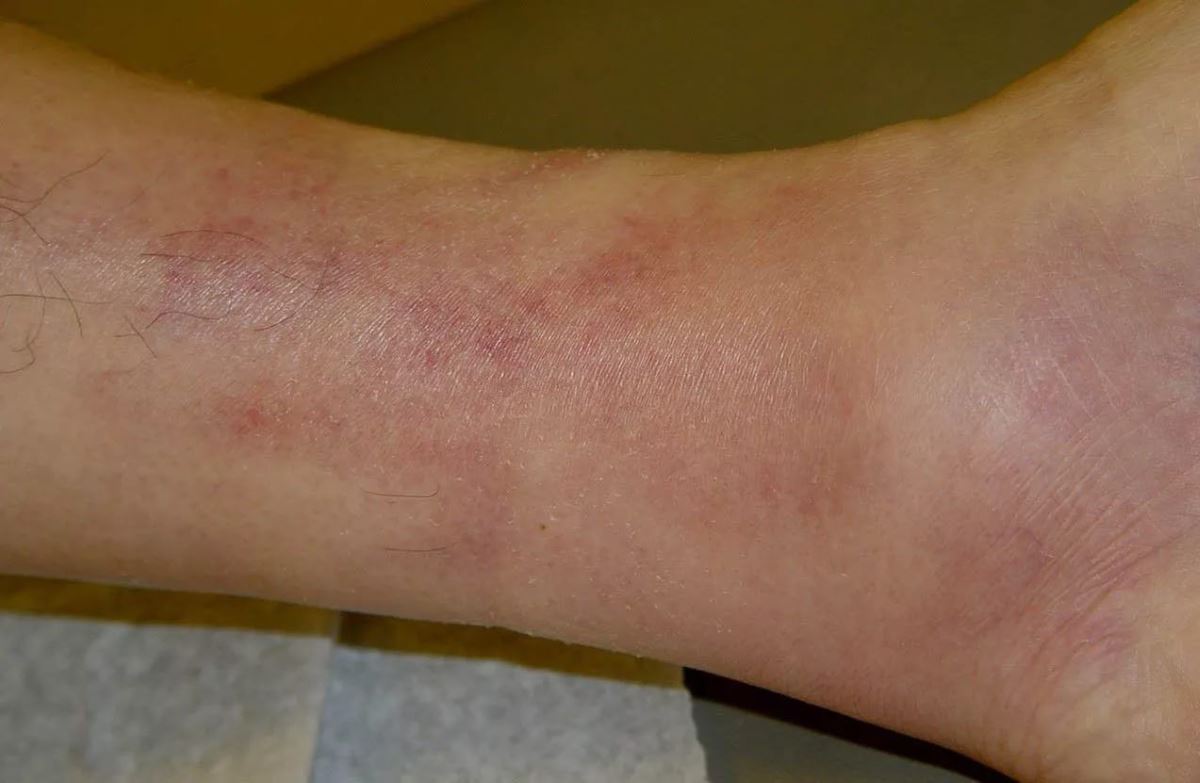 Superficial thrombophlebitis pictures