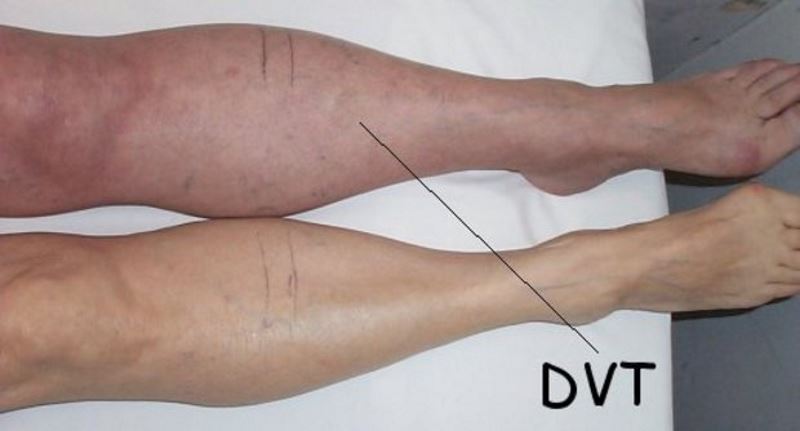 Symptoms of deep vein thrombosis photos