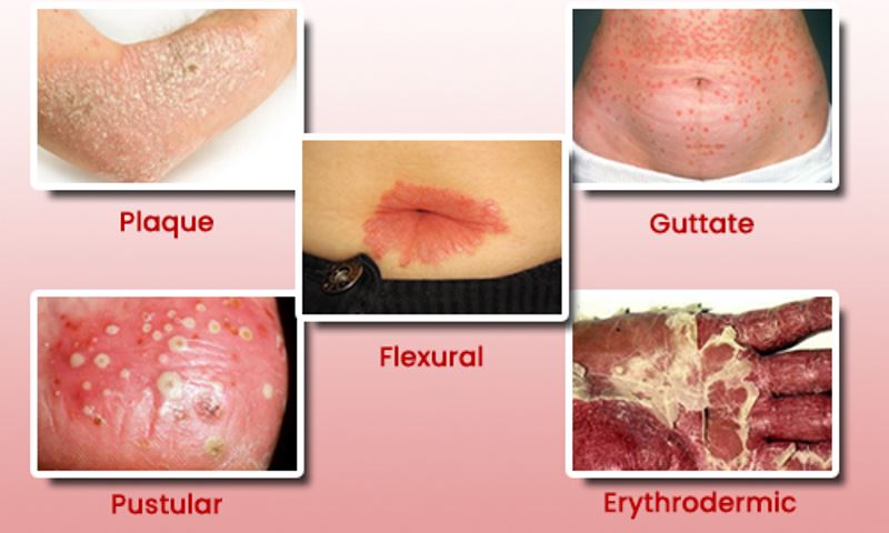 Types of psoriasis images