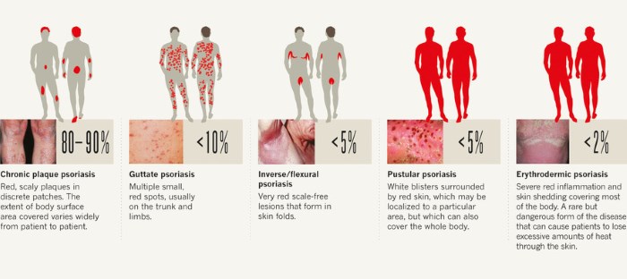 Types Of Psoriasis Pictures 1 Symptoms And Pictures 