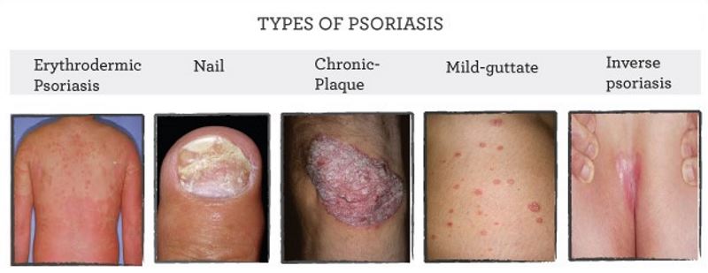 Types of psoriasis pictures 2