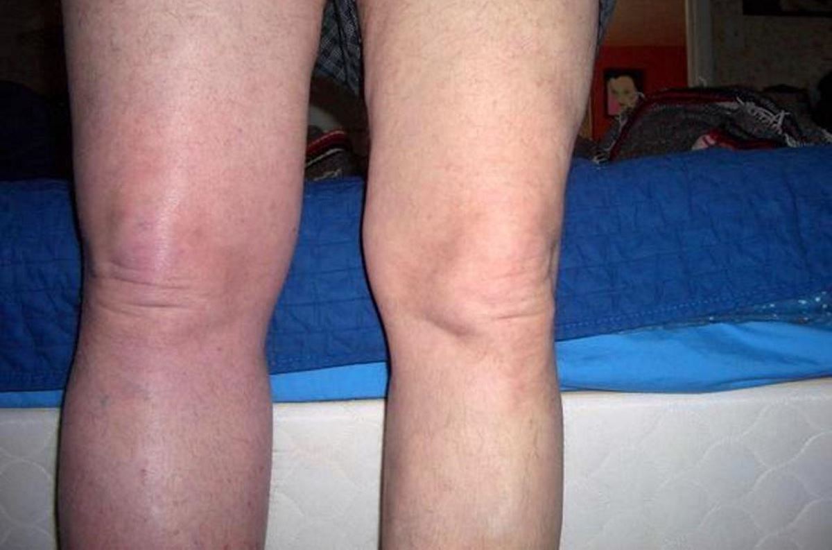 Warning signs of DVT in leg images