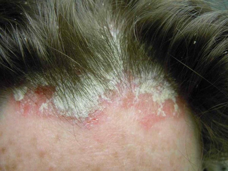 What does scalp psoriasis look like | Symptoms and pictures