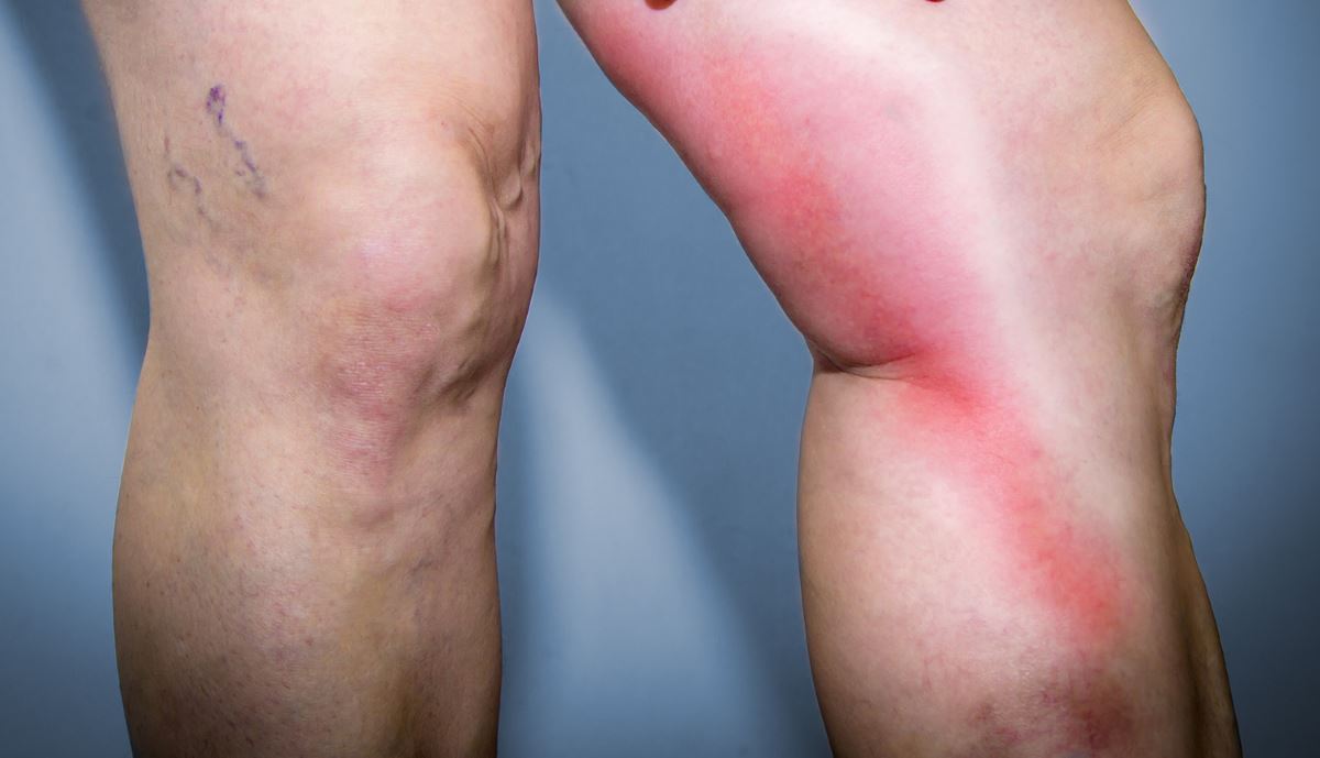 What is phlebitis pictures