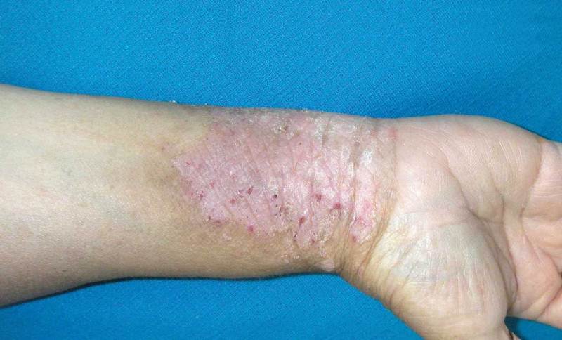 What is psoriasis look like